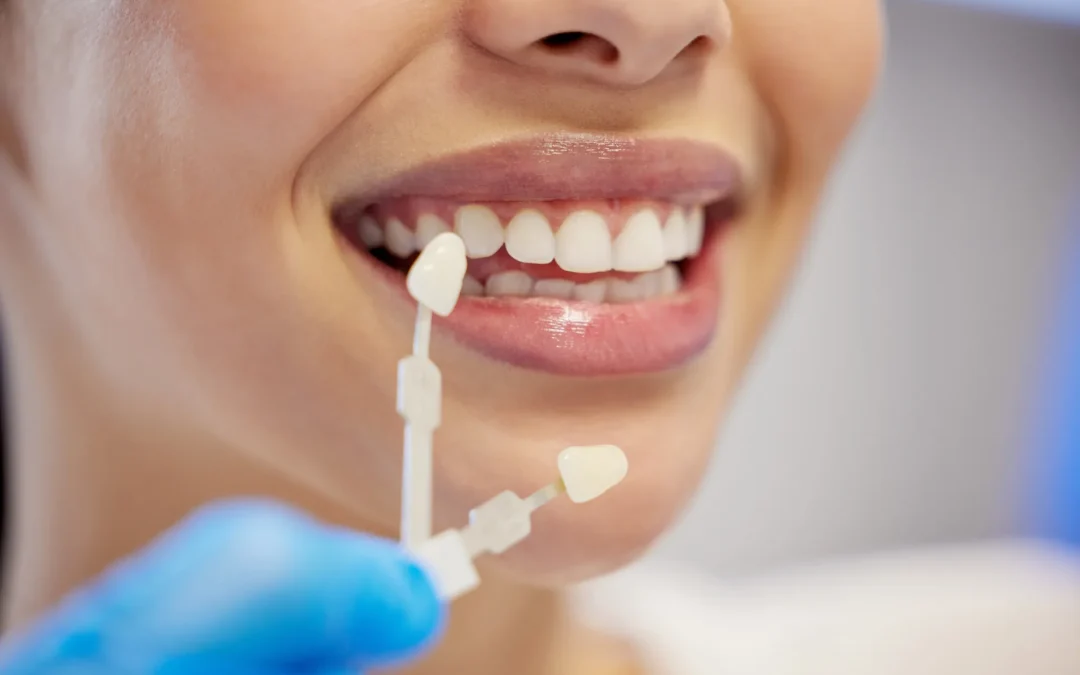 Blanqueamiento dental en Teatinos: recupera el brillo de tu sonrisa